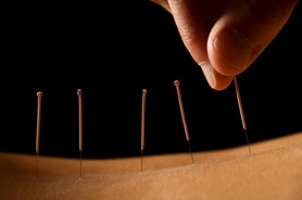 طب سوزنی چین، شفابخش فراموش شده!