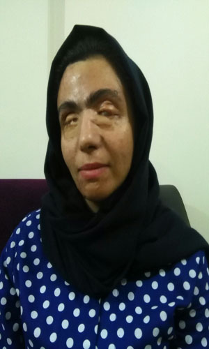 قربانیان اسیدپاشی چگونه روزگار می گذرانند؟ + تصاویر