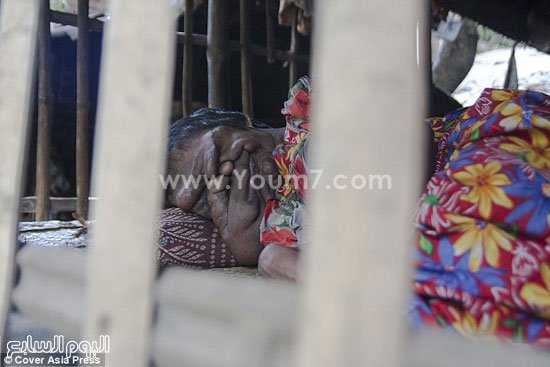 خدیجه، دختری بدون صورت که از سندروم نوروفیبروماتوز رنج می برد+تصاویر