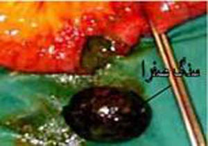 سنگ کیسه صفرا این افراد را تهدید می کند