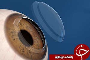 بازسازی شکستگی کاسه چشم برای نخستین بار در اهواز