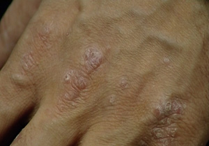 علائم بیماری خاص و نادر پوست صدفی + فیلم