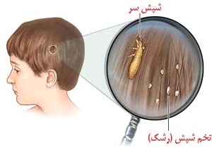 ارتباط شپش و کم‌خونی