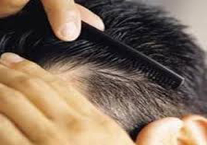 کدام ریزش مو برگشت‌پذیر است؟