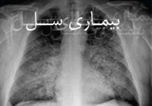لزوم تقویت سیستم ایمنی برای پیشگیری از ابتلا به سل