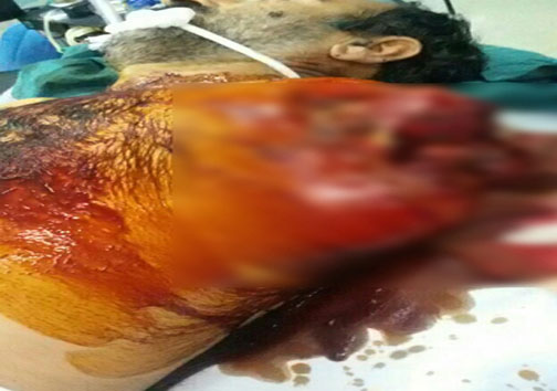 پیوند دست قطع شده کشاورز مازندرانی (+15)