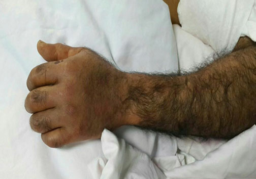 پیوند دست قطع شده کشاورز مازندرانی (+15)
