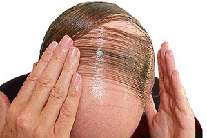موی رفته دیگه هیچ وقت نمیاد؟