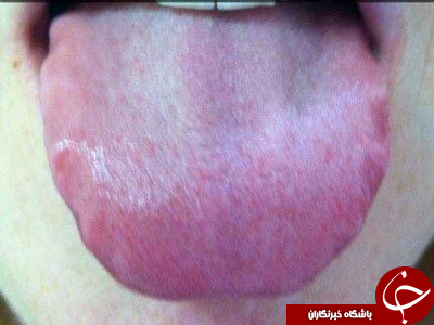 از روی زبانتان بفهمید چه بیماری&zwnj; دارید + تصاویر