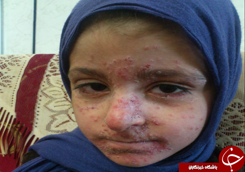 خانه&zwnj;نشینی دختربچه ۷ ساله لرستانی براثر بیماری