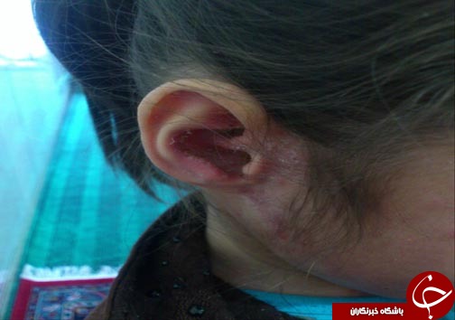 خانه&zwnj;نشینی دختربچه ۷ ساله لرستانی براثر بیماری