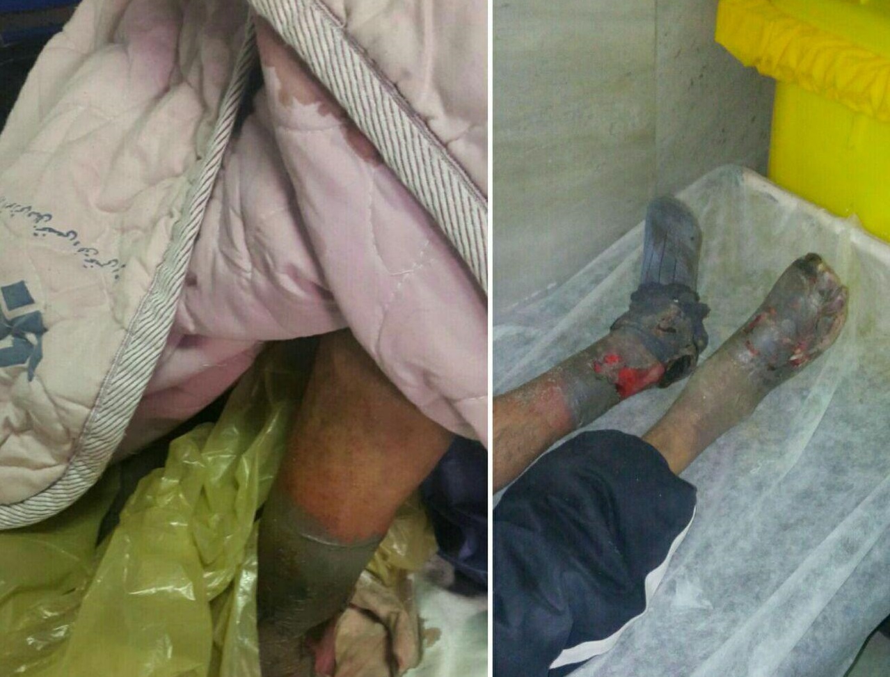 پاهای کارتن&zwnj;خواب همدانی قطع شد