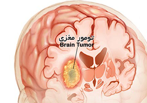 جراحی تومور مغزی در لارستان