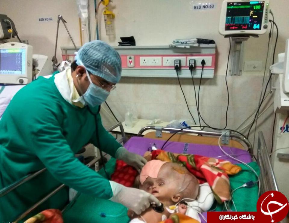 کودک هندی با بزرگترین سر جهان + تصاویر/(16+)