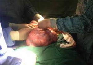 خارج کردن توده 5 کیلویی از شکم یک بیجاری