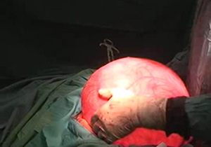 خارج کردن توده 11 کیلویی از بدن دختر 18 ساله + فیلم