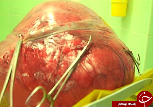 خروج توده 11 کیلویی از شکم دختر 18 ساله
