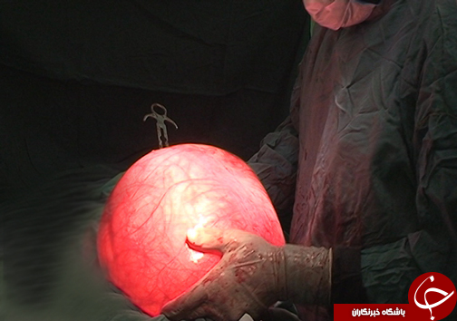 خروج توده 11 کیلویی از شکم دختر 18 ساله
