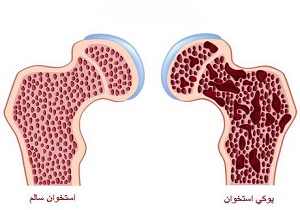 رازی که درابتلا به پوکی استخوان نمی دانید !
