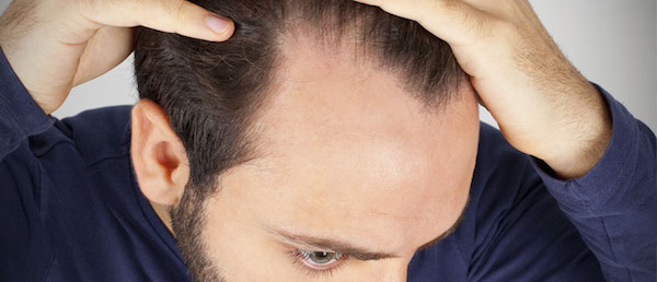 کلاه باعث کچلی در پسران می شود/ ریزش مو شدید به دلیل دم&zwnj;اسبی کردن موها!