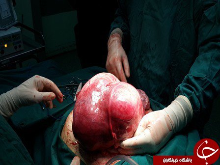 رهایی یک بیمار از غده 7 کیلویی در کرج+عکس