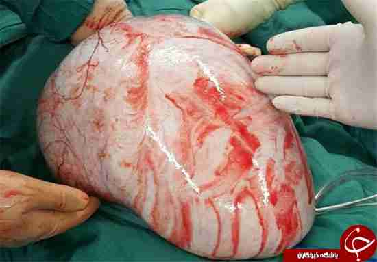 رهایی یک بیمار از غده 7 کیلویی در کرج+عکس