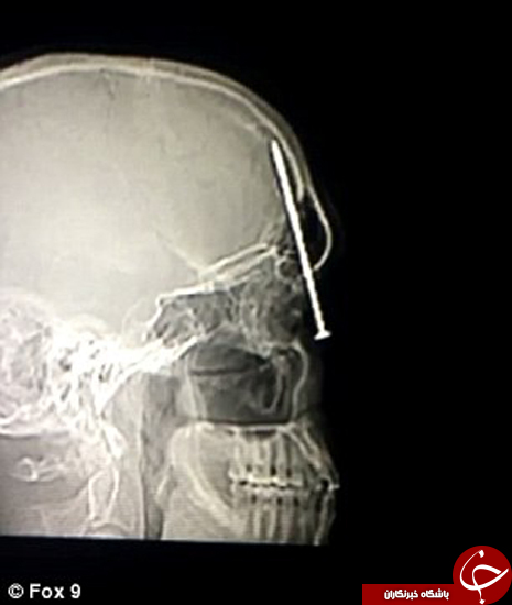 ماجرای میخی که داخل سر این مرد رفت +تصاویر
