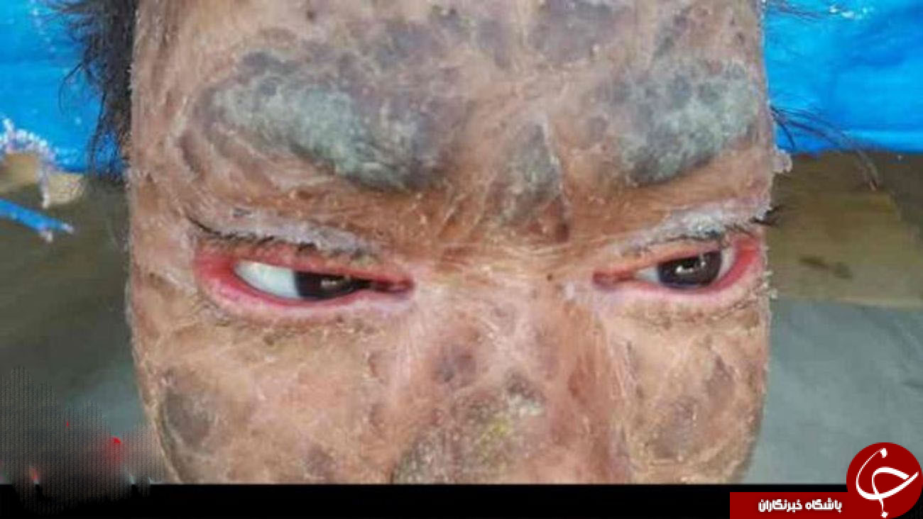 دختر پوست ماری+عکس