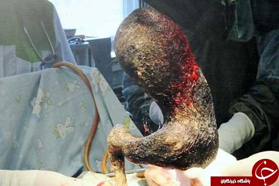 خارج کردن توده مو از معده دختر 14 ساله+ عکس