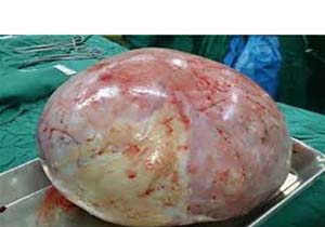 خارج کردن توده ۴ و نیم کیلوگرمی از شکم  زن مینابی