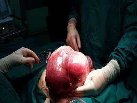 خروج توده سرطانی 5 کیلویی از شکم کودک یک ساله