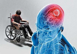 نگرانی از افزایش «ام.اس» در زنجان