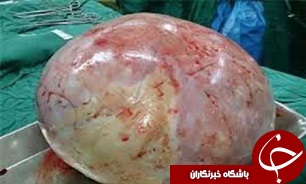 خارج کردن توده 10 کیلوگرمی از شکم بیمار+عکس