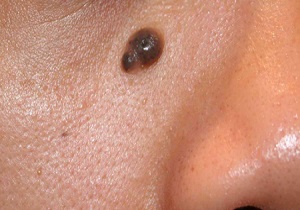منشأ خال چیست؟ / آیا وجود خال باید موجب ترس و نگرانی افراد شود؟