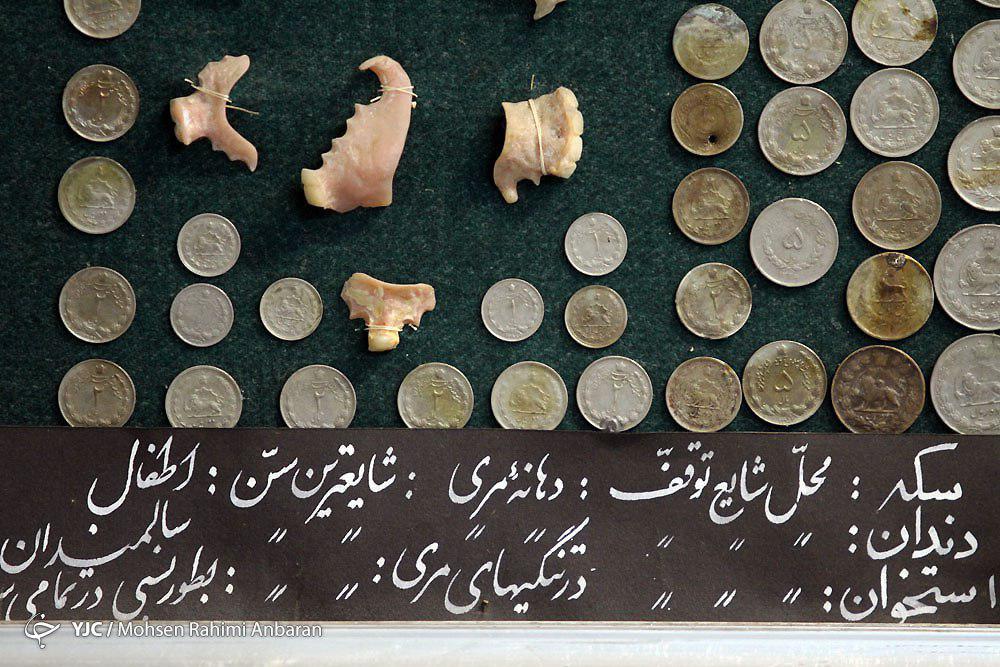 اجسامی که با تلاش پزشکان ازبدن بیماران خارج می&zwnj;شود