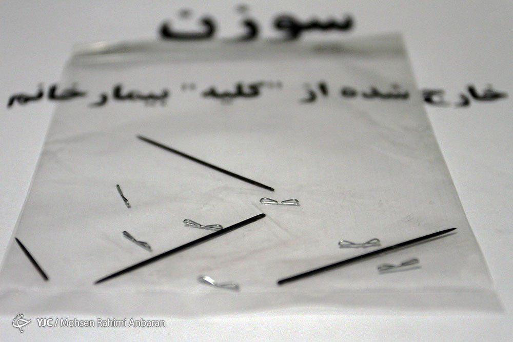 اجسامی که با تلاش پزشکان ازبدن بیماران خارج می&zwnj;شود