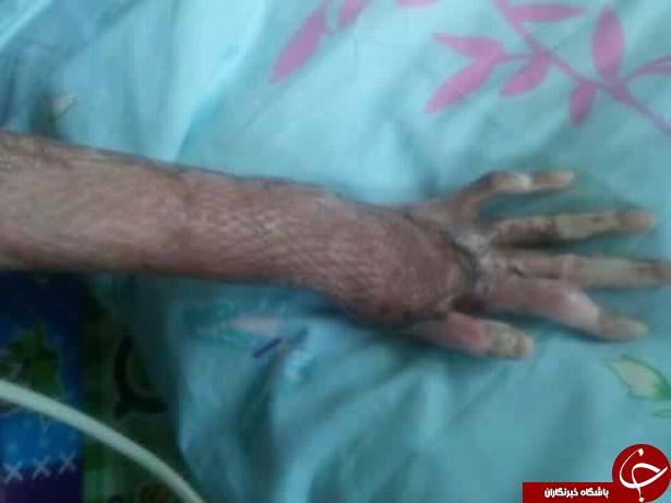 زنی که در شعله&zwnj;های حسادت همسرش سوخت شد/ تصاویر (+ ۱۸)
