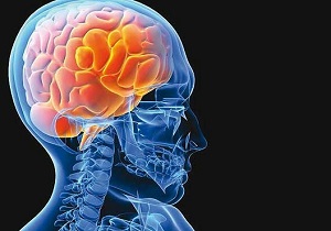 لخته عروق مغزی علت۹۰ درصد سکته‌های مغزی است