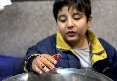 دلخراش&zwnj;ترین و وحشتناک&zwnj;ترین مصدومان چهارشنبه&zwnj;سوری 95 + تصاویر