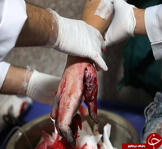تصاویری وحشتناک از مصدومین چهارشنبه سوری سال های گذشته + (16+)