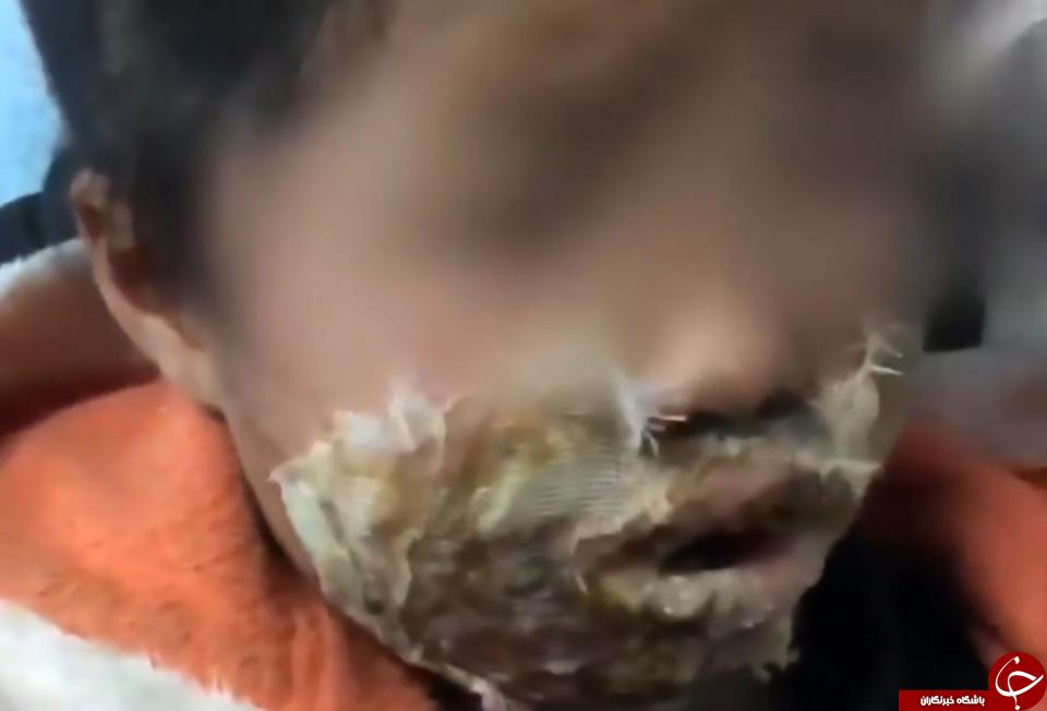 انفجار گلکسی نوت 4 دختر خردسال  را دچار سوختگی شدید کرد + تصاویر