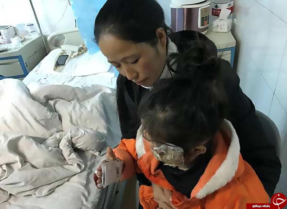انفجار گلکسی نوت 4 دختر خردسال  را دچار سوختگی شدید کرد + تصاویر