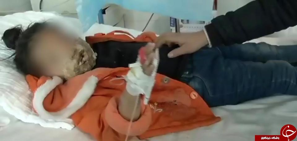انفجار گلکسی نوت 4 دختر خردسال  را دچار سوختگی شدید کرد + تصاویر