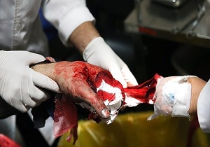 انفجار مواد محترقه در درست مرد جوان