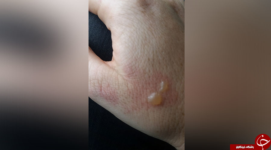 انفجار هدفون در هواپیما، صورت مسافر را سوزاند+تصاویر