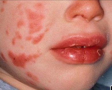 نگاهی به سندروم کاوازاکی و نشانه های آن