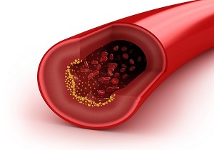 پاکسازی شریان‌ها با یک دستورالعمل طبیعی
