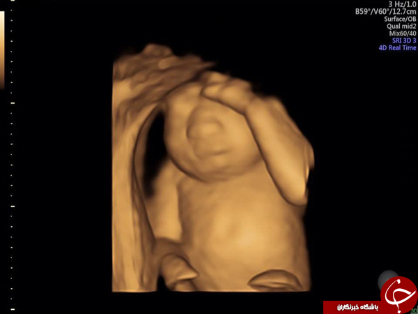 تصمیم به اهدای عضو؛ قبل از متولد شدن!