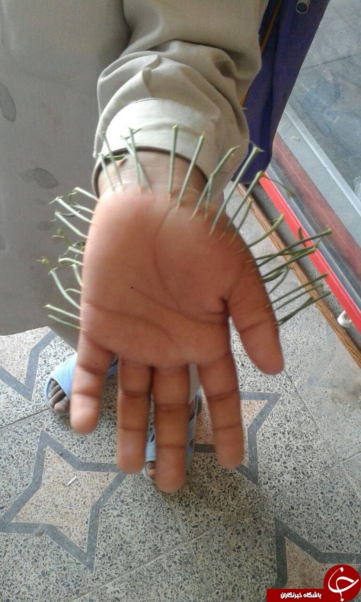 خاری که به جان این کودک نشست! + تصاویر