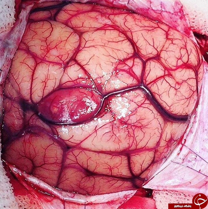 نمایی نزدیک و خارق العاده از تومور مغزی+ عکس